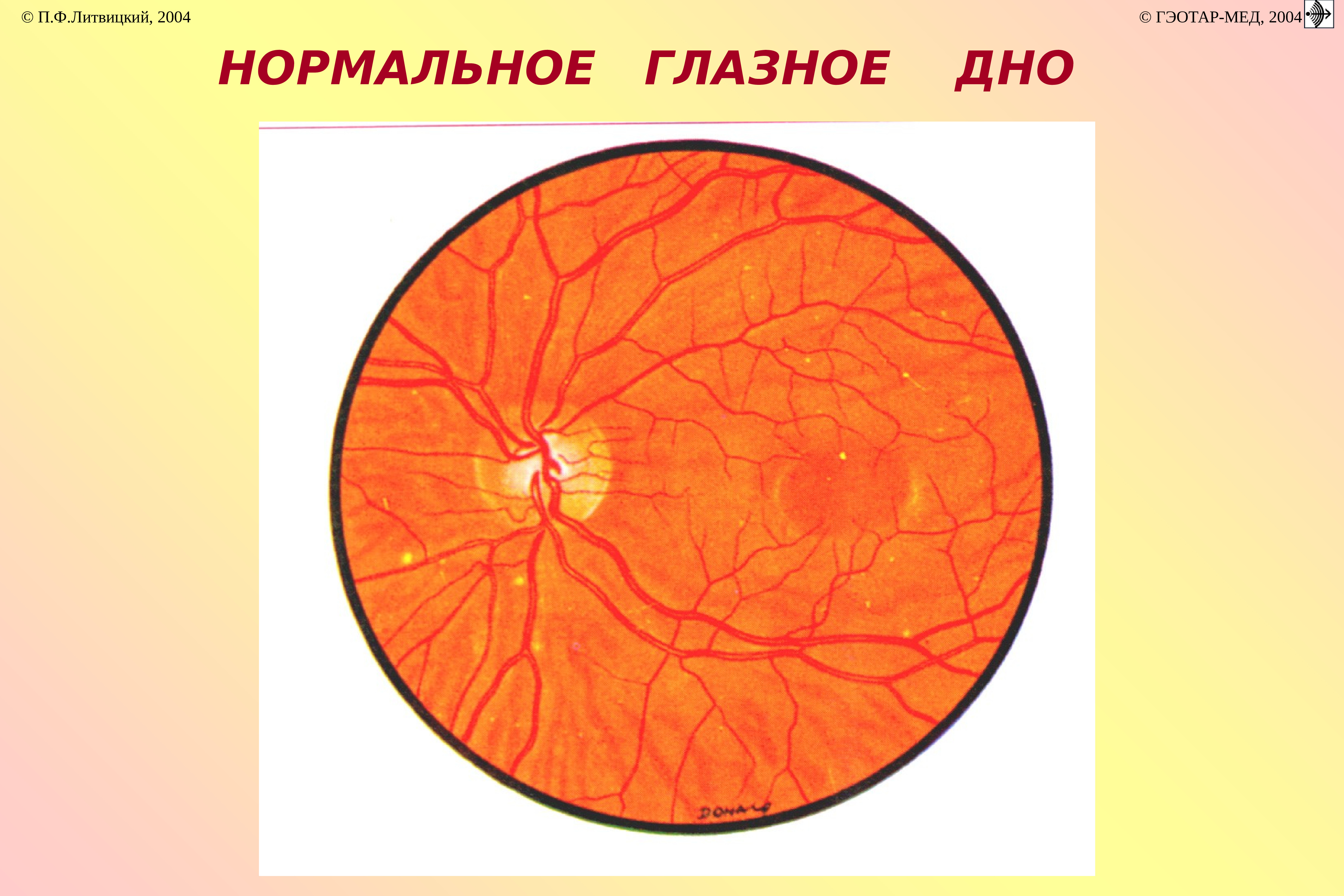 Норма глазного дна. Схема глазного дна норма. Глазное дно норма рисунок. Глазное дно при офтальмоскопии норма. Строение глазного дна.