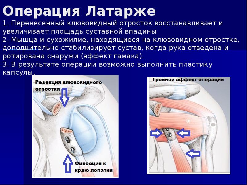 Банкарта плечевого сустава. Операция Банкарта и Латарже. Операция по Бристоу-Латарже. Операция Латарже на плечевом суставе что это.