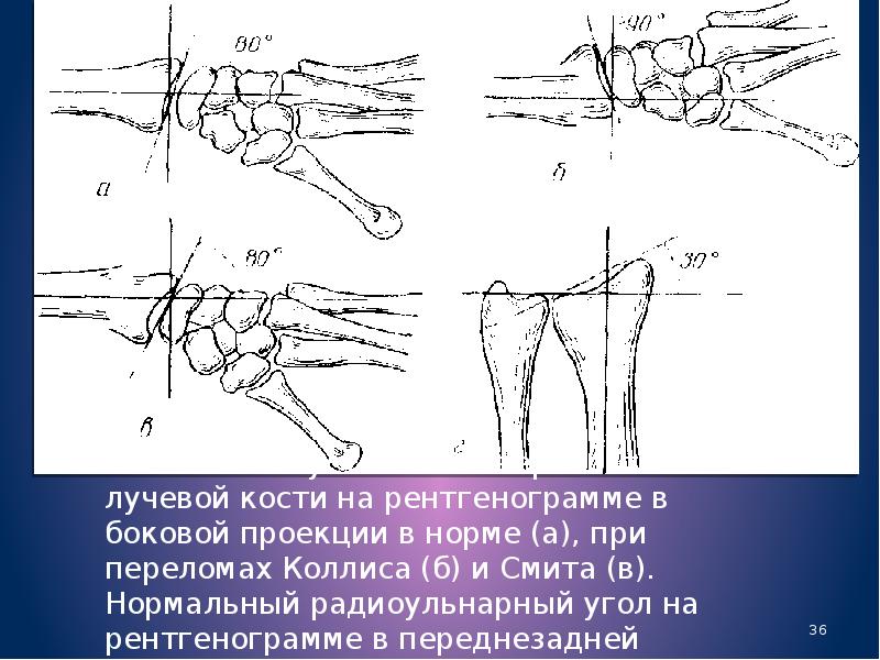 Перелом предплечья травматология презентация