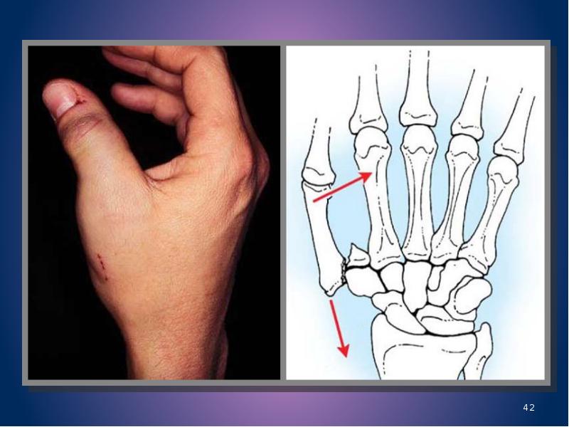 Вывих кисти. Перелом Беннета 1 пястной кости. Сгибательный перелом 1 пястной кости. Перелом первой пястной кости перелом Беннета. Перелом Беннета со смещением.