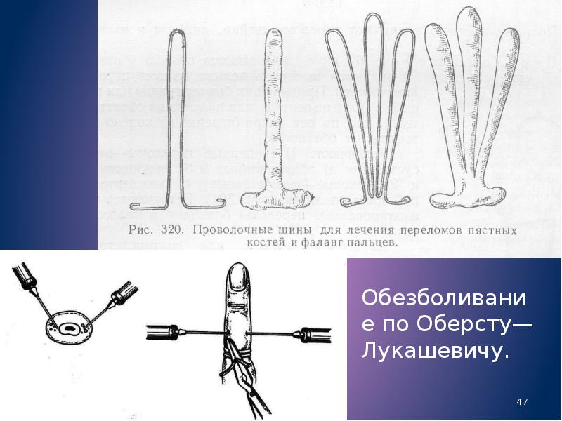 Травмы кисти презентация