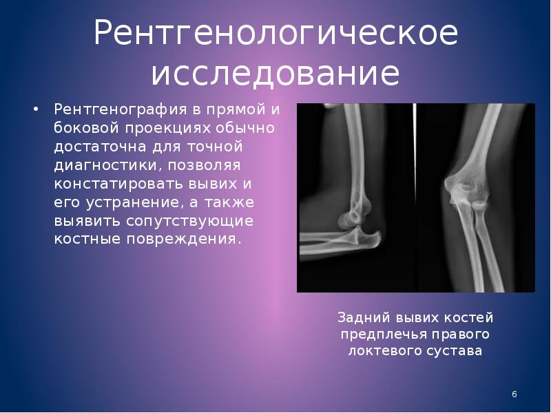 Переломы травматология презентация