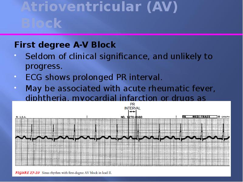 Av block. Av Block ECG 1 degree. Av Block ECG 2 degree. First degree av Block. Av Block 1 degree.