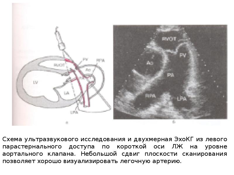 Узи сердца схема