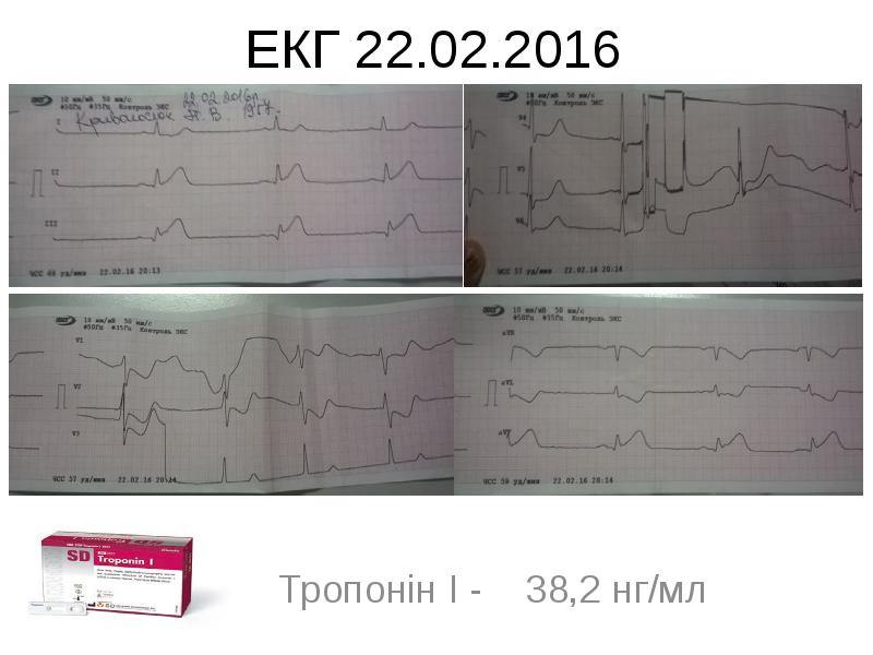 Тропонін І - 38,2 нг/мл Тропонін І - 38,2 нг/мл