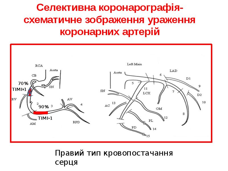 Селективна коронарографія- схематичне зображення ураження коронарних артерій Селективна коронарографія- схематичне зображення ураження коронарних артерій