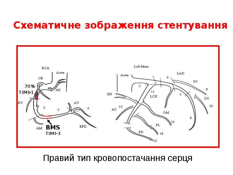 Cхематичне зображення стентування Cхематичне зображення стентування