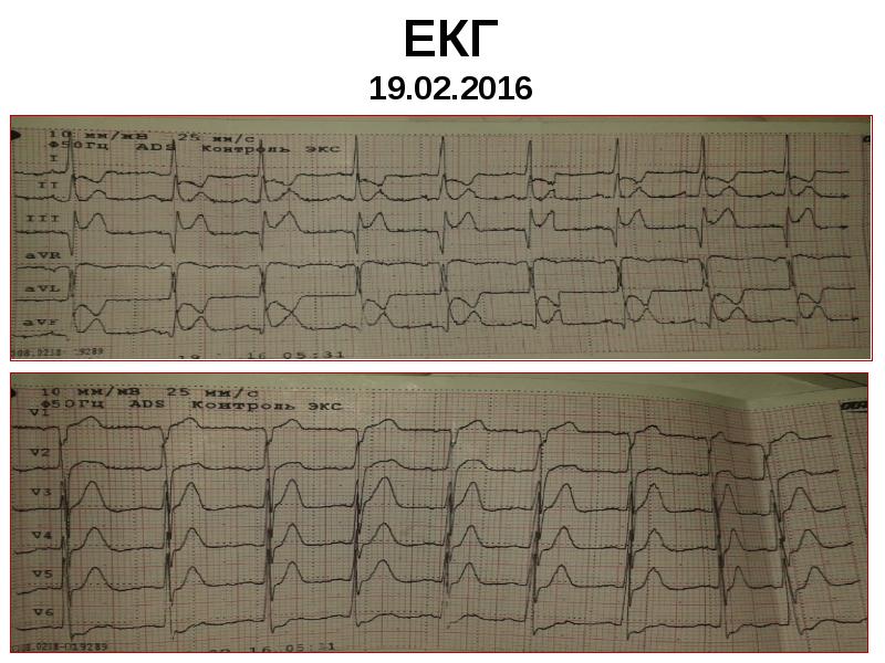ЕКГ 19.02.2016 ЕКГ 19.02.2016