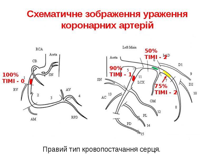 Схематичне зображення ураження коронарних артерій Схематичне зображення ураження коронарних артерій
