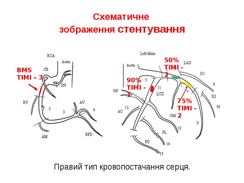 Схематичне зображення стентування Схематичне зображення стентування