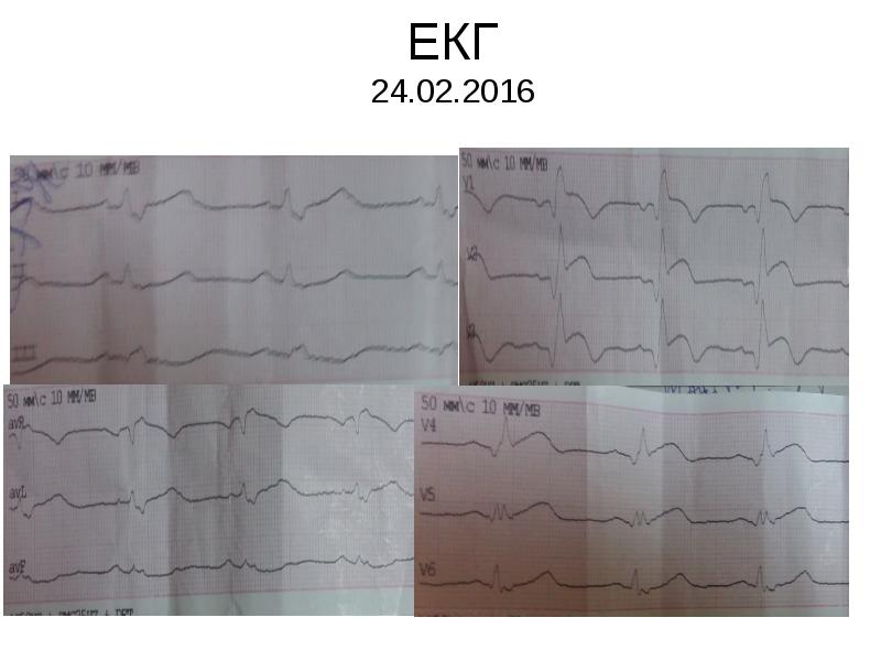 ЕКГ 24.02.2016 ЕКГ 24.02.2016