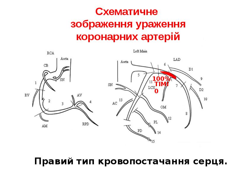 Схематичне зображення ураження коронарних артерій Схематичне зображення ураження коронарних артерій