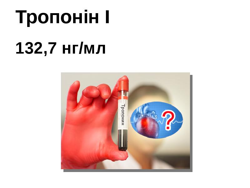 Тропонін І 132,7 нг/мл Тропонін І 132,7 нг/мл