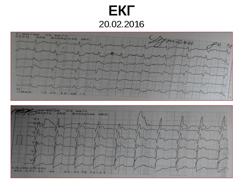ЕКГ 20.02.2016 ЕКГ 20.02.2016