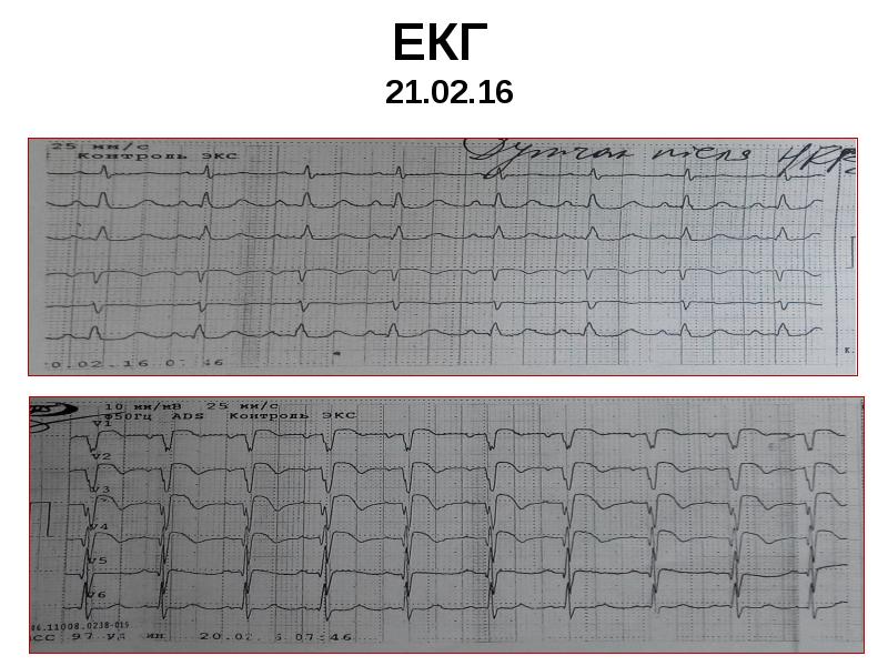 ЕКГ 21.02.16 ЕКГ 21.02.16