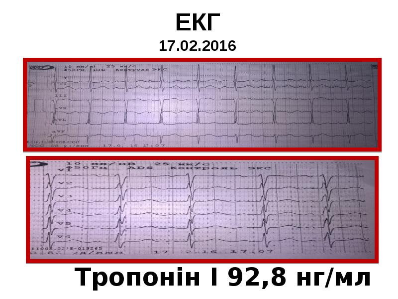 ЕКГ 17.02.2016 ЕКГ 17.02.2016