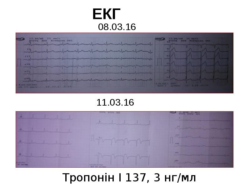 ЕКГ
08.03.16 ЕКГ
08.03.16
