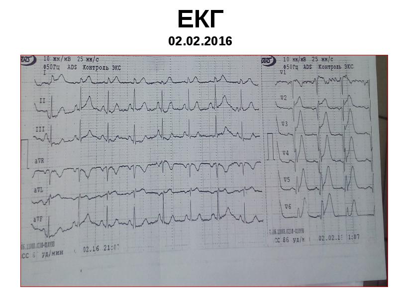ЕКГ 02.02.2016 ЕКГ 02.02.2016