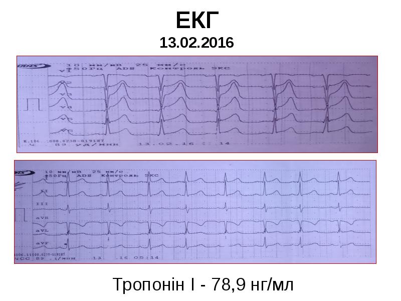 ЕКГ 13.02.2016 ЕКГ 13.02.2016