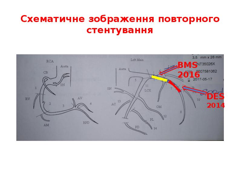 Cхематичне зображення повторного стентування Cхематичне зображення повторного стентування