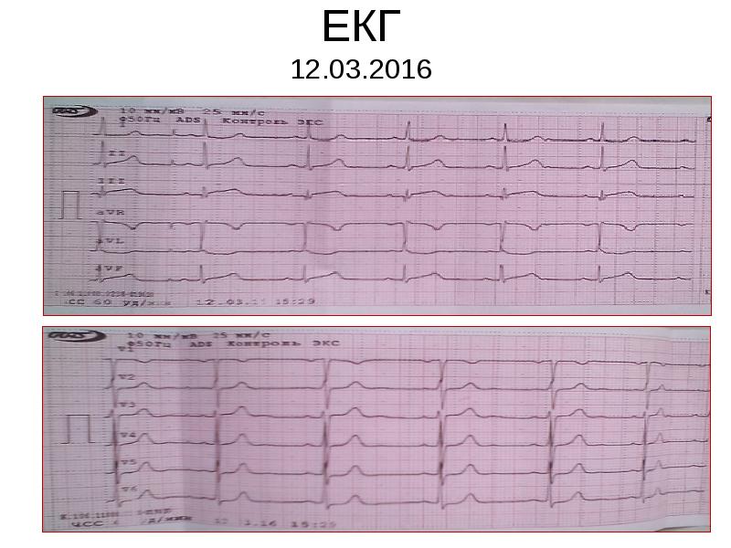 ЕКГ 12.03.2016 ЕКГ 12.03.2016