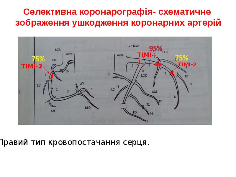 Селективна коронарографія- схематичне зображення ушкодження коронарних артерій Селективна коронарографія- схематичне зображення ушкодження коронарних артерій