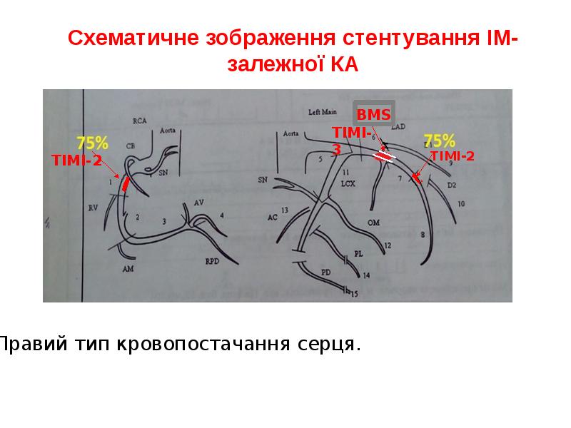 Схематичне зображення стентування ІМ- залежної КА Схематичне зображення стентування ІМ- залежної КА