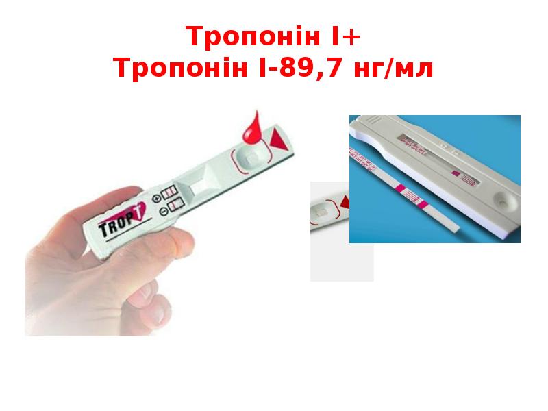 Тропонін І+ Тропонін І-89,7 нг/мл Тропонін І+ Тропонін І-89,7 нг/мл