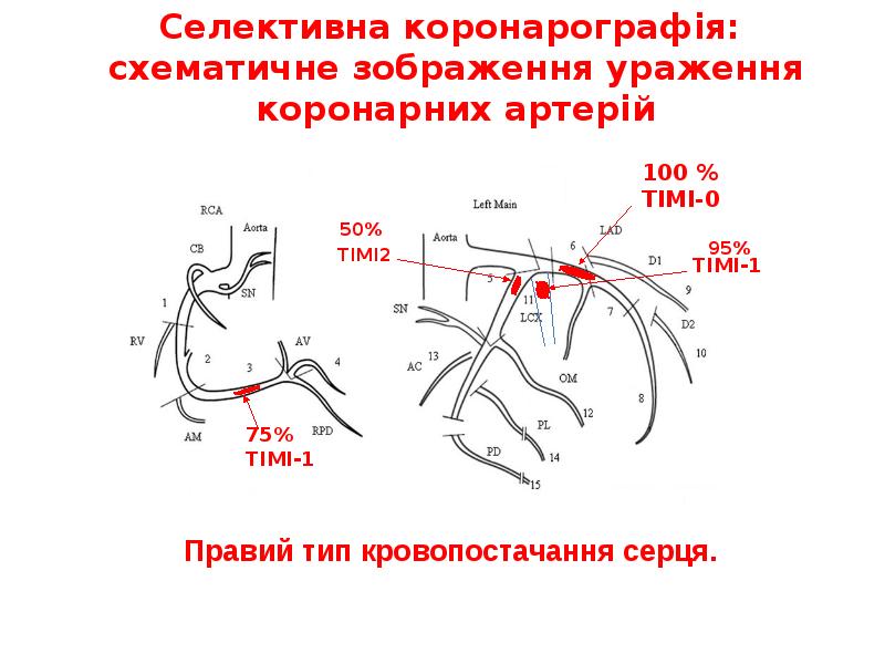 Селективна коронарографія: схематичне зображення ураження коронарних артерій Селективна коронарографія: схематичне зображення ураження коронарних артерій