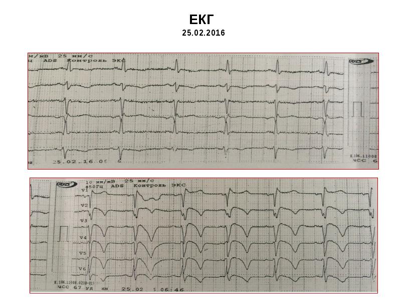 ЕКГ 25.02.2016 ЕКГ 25.02.2016