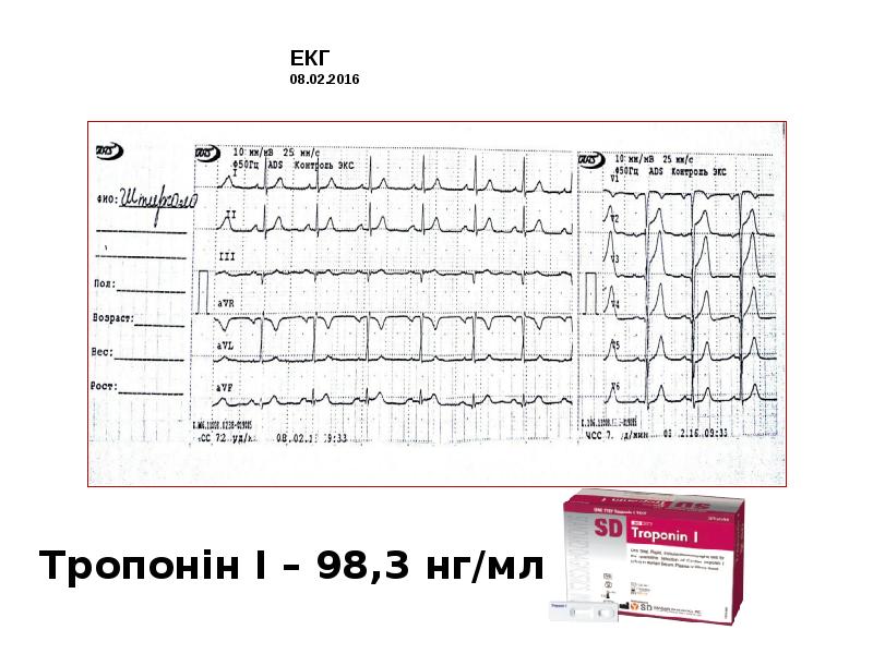 ЕКГ 08.02.2016 ЕКГ 08.02.2016