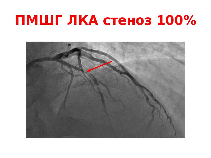 ПМШГ ЛКА стеноз 100% ПМШГ ЛКА стеноз 100%