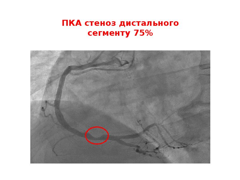 ПКА стеноз дистального сегменту 75% ПКА стеноз дистального сегменту 75%