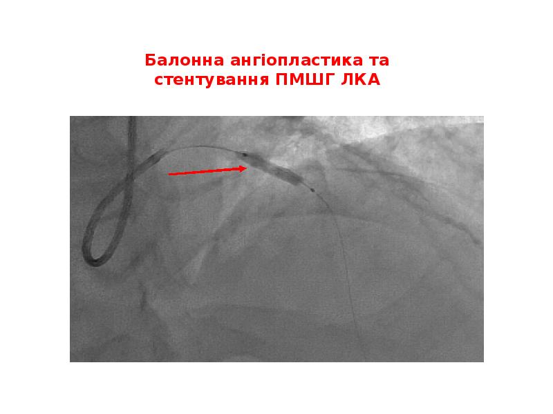 Балонна ангіопластика та стентування ПМШГ ЛКА Балонна ангіопластика та стентування ПМШГ ЛКА