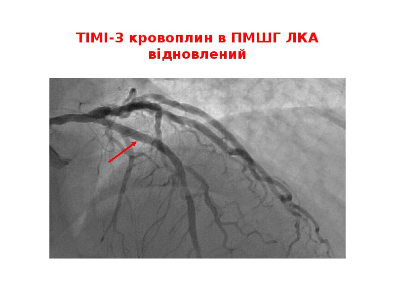 ТІМІ-3 кровоплин в ПМШГ ЛКА відновлений ТІМІ-3 кровоплин в ПМШГ ЛКА відновлений
