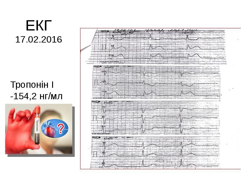 ЕКГ 17.02.2016 ЕКГ 17.02.2016