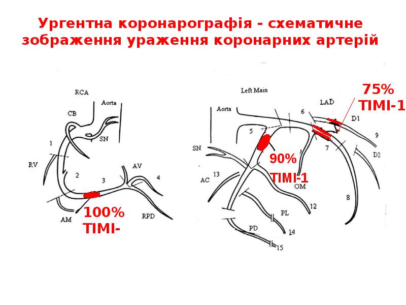 Ургентна коронарографія - схематичне зображення ураження коронарних артерій Ургентна коронарографія - схематичне зображення ураження коронарних артерій