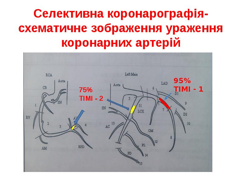 Селективна коронарографія- схематичне зображення ураження коронарних артерій Селективна коронарографія- схематичне зображення ураження коронарних артерій