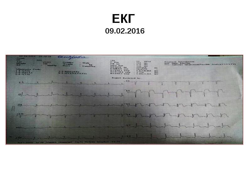 ЕКГ 09.02.2016 ЕКГ 09.02.2016