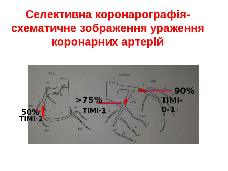 Селективна коронарографія- схематичне зображення ураження коронарних артерій Селективна коронарографія- схематичне зображення ураження коронарних артерій