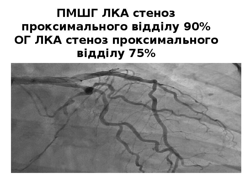 ПМШГ ЛКА стеноз проксимального відділу 90% ОГ ЛКА стеноз проксимального відділу ПМШГ ЛКА стеноз проксимального відділу 90% ОГ ЛКА стеноз проксимального відділу