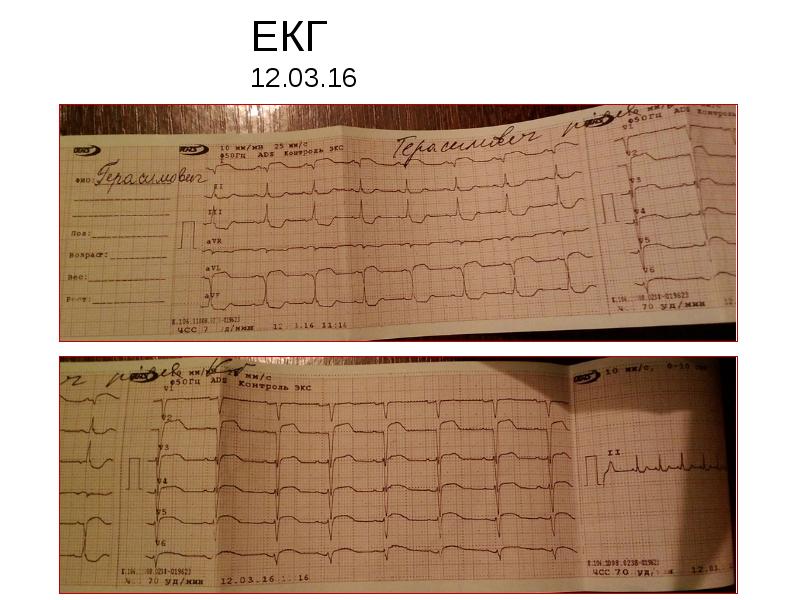ЕКГ 12.03.16 ЕКГ 12.03.16