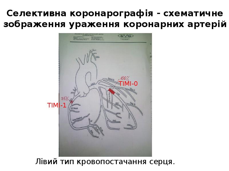 Селективна коронарографія - схематичне зображення ураження коронарних артерій Селективна коронарографія - схематичне зображення ураження коронарних артерій