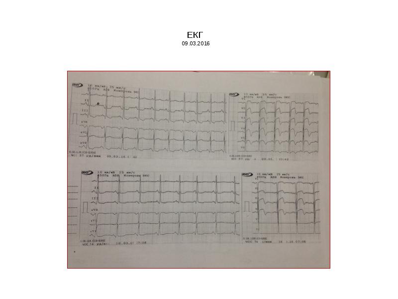 ЕКГ 09.03.2016 ЕКГ 09.03.2016