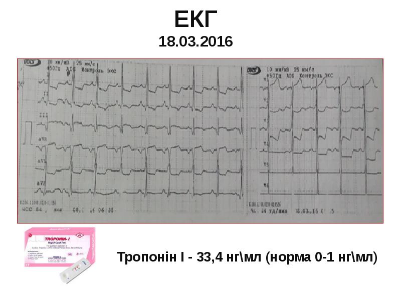 ЕКГ 18.03.2016 ЕКГ 18.03.2016