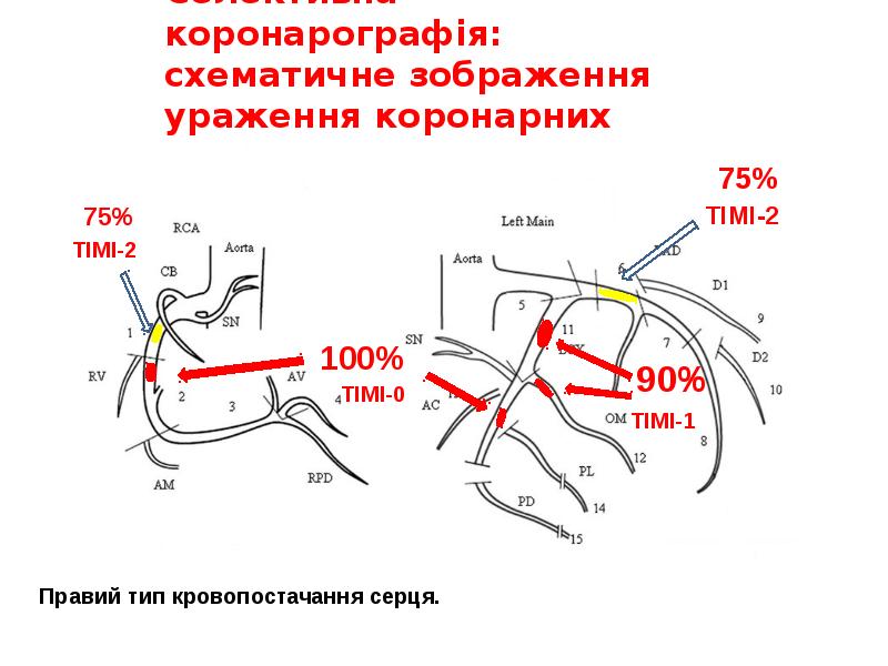 Селективна коронарографія: схематичне зображення ураження коронарних артерій Селективна коронарографія: схематичне зображення ураження коронарних артерій