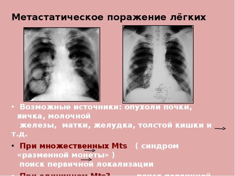 Лекарственное поражение легких презентация