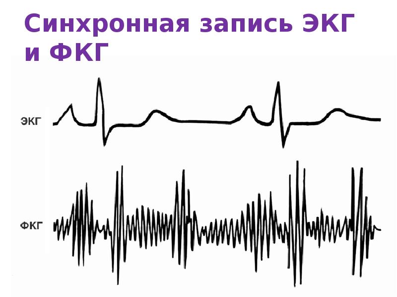 Синхронная запись ЭКГ и ФКГ