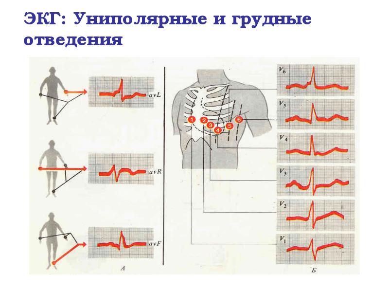 ЭКГ: Униполярные и грудные отведения ЭКГ: Униполярные и грудные отведения