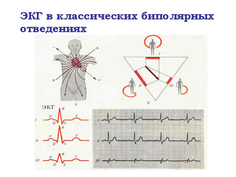 ЭКГ в классических биполярных отведениях ЭКГ в классических биполярных отведениях